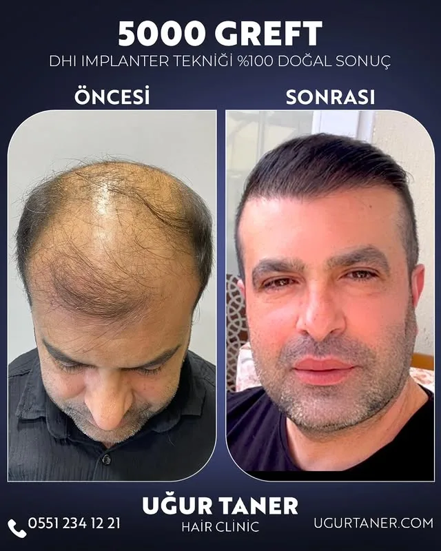 5000 greft DHI saç ekimi vaka paylaşımı – Uğur Taner Hair Clinic Instagram