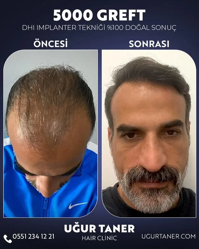 5000 greft DHI saç ekimi vaka paylaşımı – Uğur Taner Hair Clinic Instagram