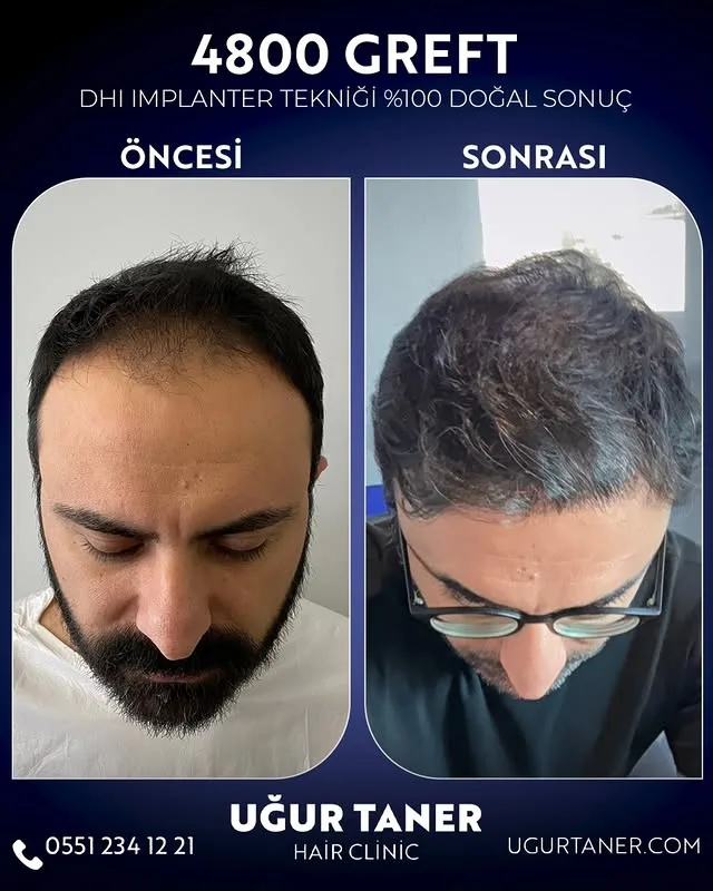 4800 greft DHI saç ekimi vaka paylaşımı – Uğur Taner Hair Clinic Instagram