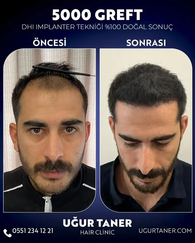 5000 greft DHI saç ekimi vaka paylaşımı – Uğur Taner Hair Clinic Instagram